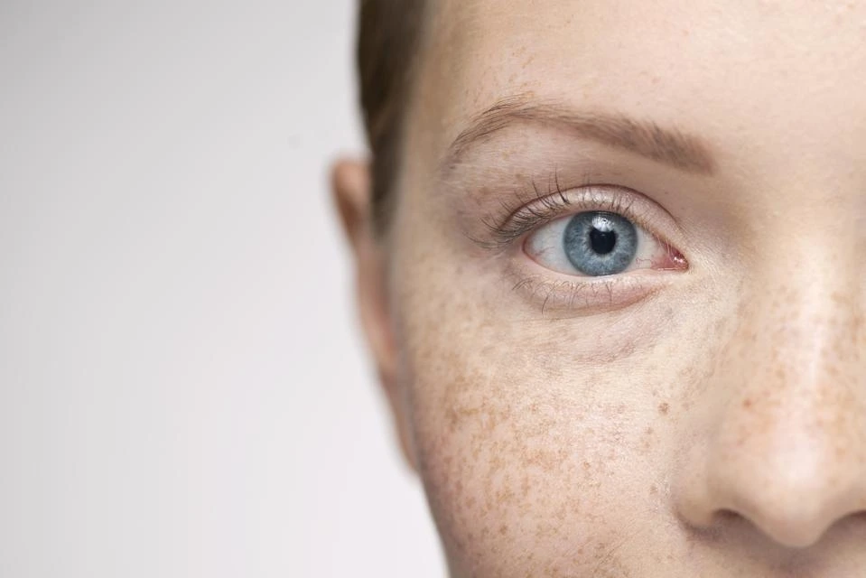 Understanding Sun Damage: How UV Rays Alter Skin and How CryoPen Can Reverse It Wigan