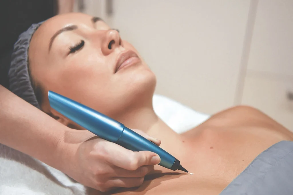 What is CryoPen Technology Wigan? Wigan