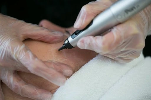 The CryoPen Technology Explained: How Extreme Cold Removes Sun-Damaged Skin Cells Wigan