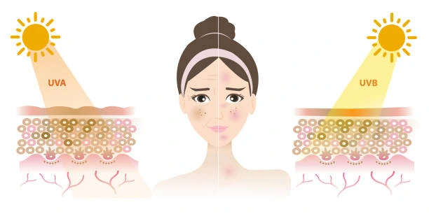 Understanding Sun Damage Wigan : How Do UV Rays Cause Changes in the Skin? Wigan