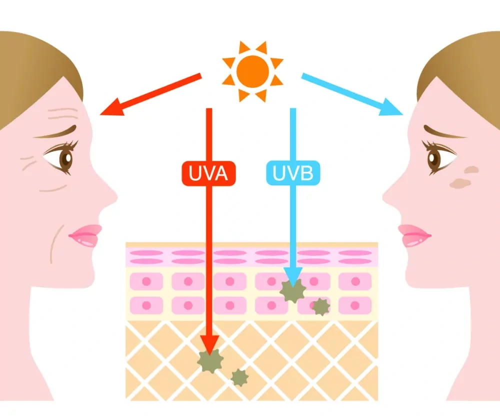 Understanding Sun Damage Wigan - Why Should Sun Damage Be Treated Early? Wigan
